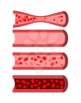 Anatomical human blood vessels set. Healthy blood vessel. Diseased artery blood. Dark purple in Dense blood vein. Vessel with a small amount of white blood cells. Human blood cells.
