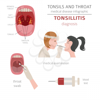 Tonsils and throat diseases. Tonsillitis symptoms, treatment icon set. Medical infographic design. Vector illustration