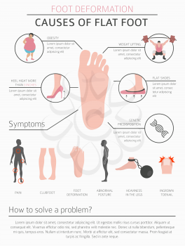 Foot deformation as medical desease infographic. Causes of Flat foot. Vector illustration