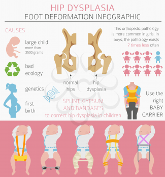 Foot deformation types,  medical desease infographic. Hip dysplasia in children. Vector illustration