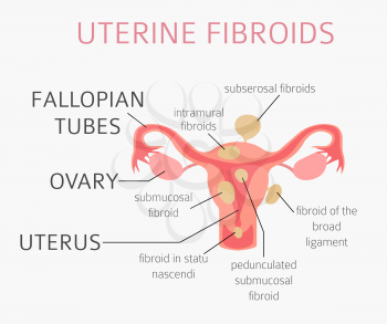 Uterine fibroids. Ginecological medical desease in women infographic. Vector illustration