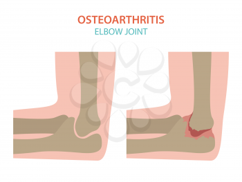 Arthritis, osteoarthritis medical infographic design. Joint replacement, implantant. Vector illustration