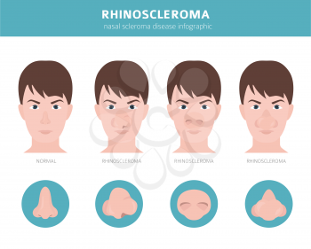 Nasal diseases. Rhinoscleroma symptoms, nasal scleroma treatment icon set. Medical infographic design. Vector illustration