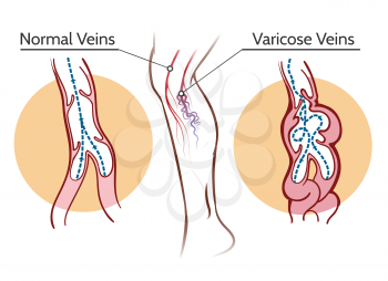 Varicose veins. Healthy leg vascular system and vessels thrombosis vector illustration
