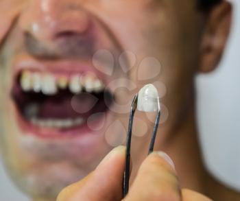 Dental prosthesis of metal ceramics in tweezers. A patient without a tooth is trying on a denture. Tooth implantation, dental treatment.