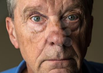 Close up of an elderly caucasian man with black eye
