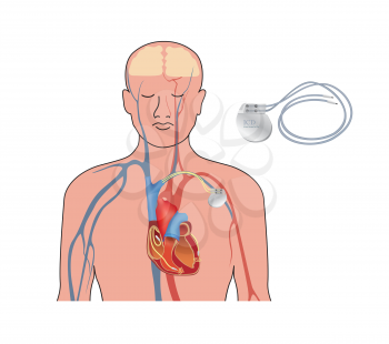 Heart pacemaker. Human heart anatomy cross section with working implantable cardioverter defibrillator.