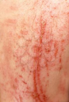 Closeup of bloody big scrapes and wounds on the human skin.