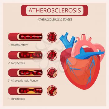 Atherosclerosis stages. Heart strokes thrombus attack blood circulatory system vector medical infographics. Cholesterol artery, heart human and cardiovascular system illustration