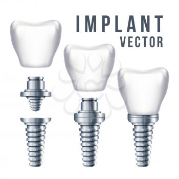 Dental tooth implant and parts vector illustration. Implantation dentistry and care to teeth