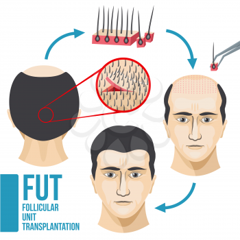 Male hair loss treatment medical vector infographic. Disease hair and baldness, growth and transplant hair illustration