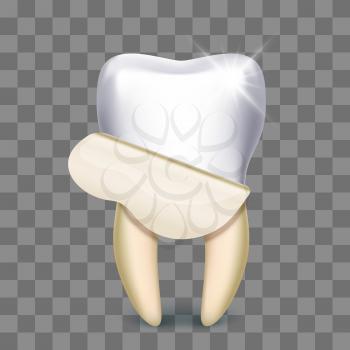 Tooth veneer whitening dental technician isolated on transparent background. Vector illustration
