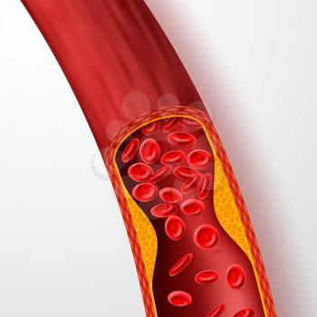 Blocked blood vessel, artery with cholesterol thrombus. 3d vein with clot vector illustration. Medical artery blood, cholesterol disease, blocked flow circulation