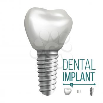 Dental Implant Vector. Side View. Graphic Design Element. Tooth Paste Poster. Realistic Isolated Illustration