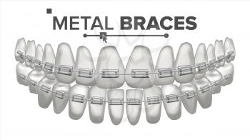 Metal Braces Vector. Human Jaw. Braces On Teeth. Smile With Braces. Realistic Isolated Illustration
