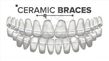 Ceramic Braces Vector. Human Jaw. Dentist, Orthodontist Poster Element. Isolated Illustration