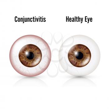 Conjunctivitis. Red Eye. Healthy Eye And Eyeball with Conjunctivitis. Vector