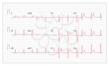 Heart Cardiogram Chart Vector. Set Healthy Heart Rhythm, Ischemia, Infarction. Vitality Heartbeat, Heart Electrocardiogram, Pulse